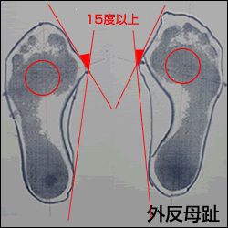 フットケア・フットプリント・外反母趾・開帳足