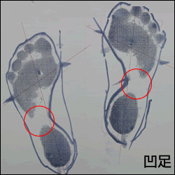 フットケア・フットプリント・凹足